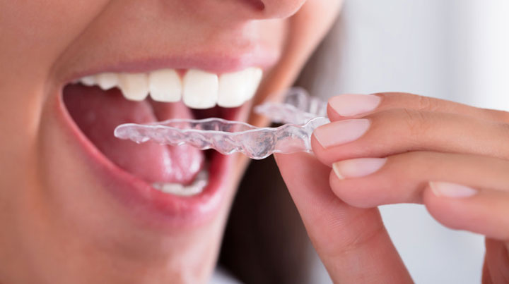 night guard teeth dentist cloverdale